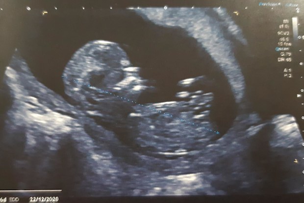 A sonogram image from when Lauren Van Dalen was pregnant with her son Ezra.