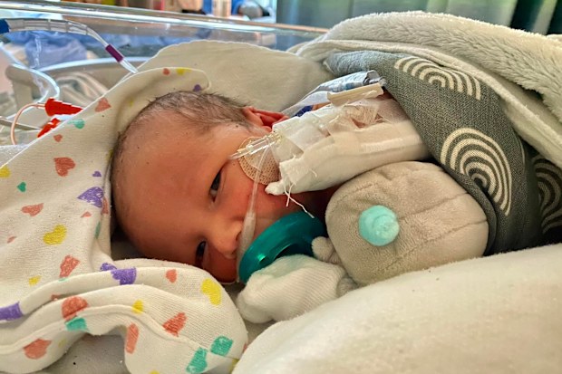 Baby Oliver after rare exit procedure. 