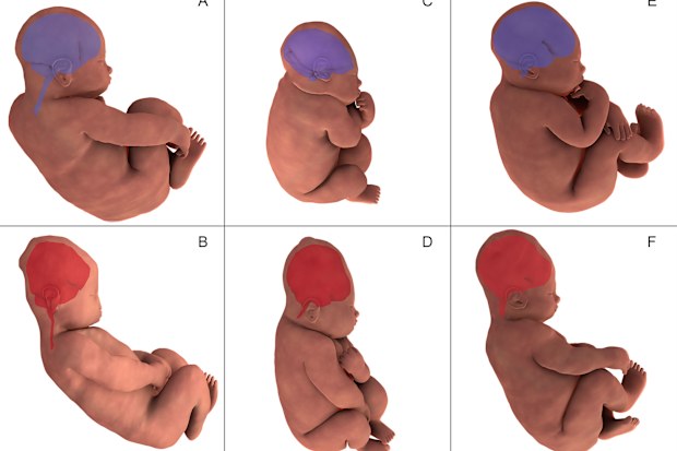 Foetal head moulding