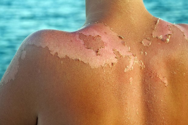 Peeling sunburned back