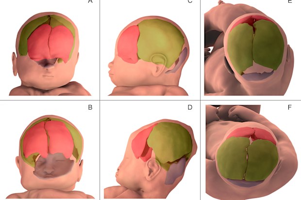 Foetal head moulding