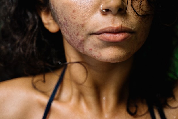 Stock photo: woman with acne poses with a leaf.