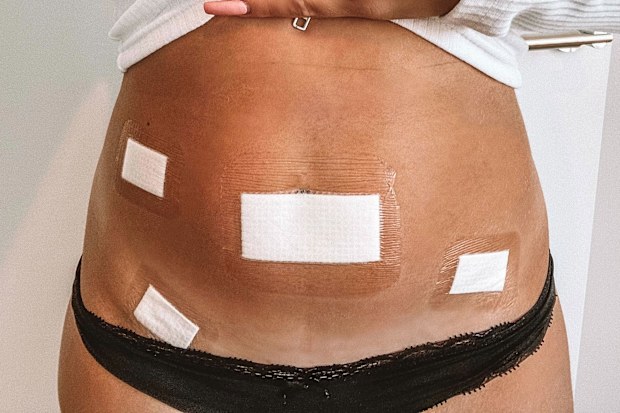 Surgery for endometriosis has left Ella Collings with scars on her stomach. 
