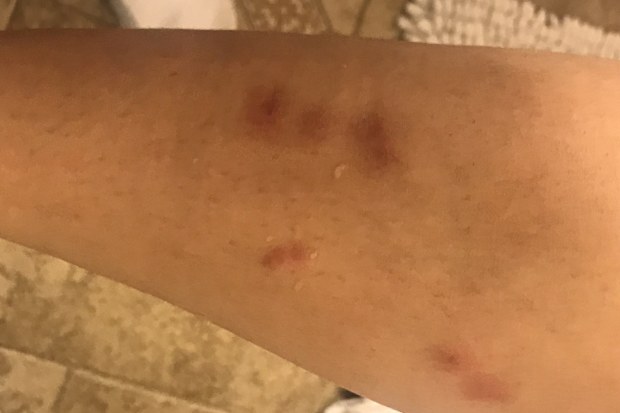 Actress suing cruise line for bed bugs