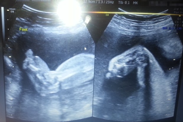 This sonogram image showed the swelling in Mia-Rose's legs and feet before she was even born.