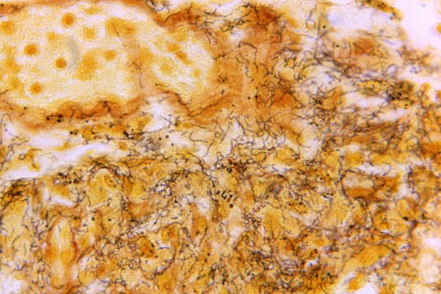 A microscope photo shows a tissue sample of Treponema pallidum spirochetes, the bacterium responsible for causing syphilis.