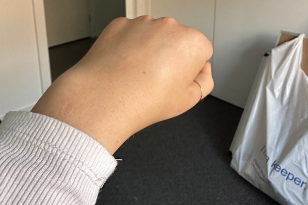 Tayla Greelish's wrists swell up painfully when her RA flares up.