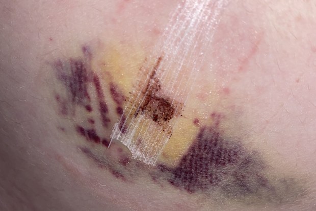 A shocking bruise after Caitlin Tiernan's endometriosis surgery.