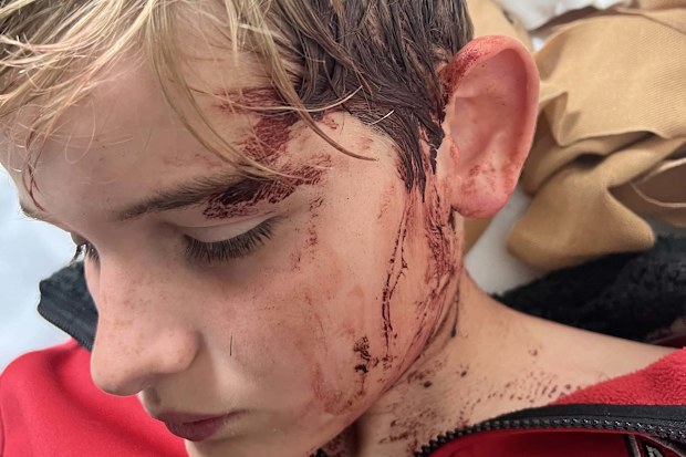 Phoenix, 12, was attacked by a big male kangaroo at home in Victoria.