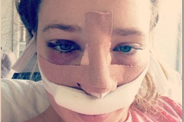 Jess Hosking shows the results of her cleft surgeries.