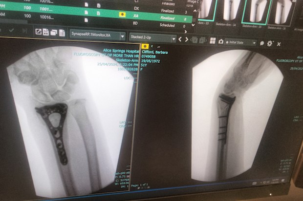 An x-ray of Barbara's wrist post-surgery, with a titanium plate insert