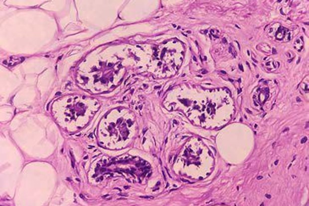 Microscopic image of malignant melanoma in pigmented ulcer (MD Abul Hosen/Getty)