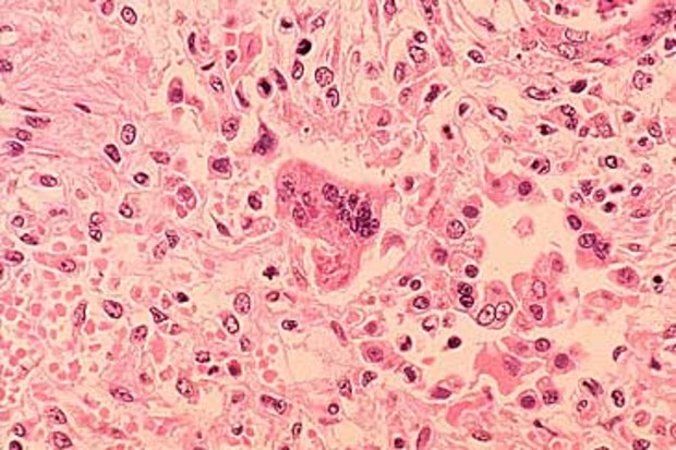 Microscopic image of measles infection (Getty)