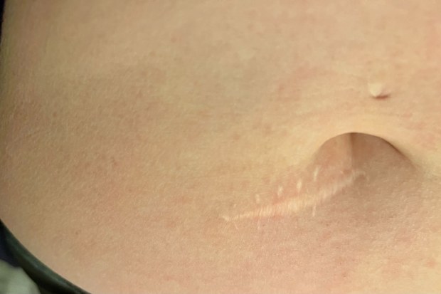 The scar on Madelaine Wigham's stomach where the melanoma was cut out.