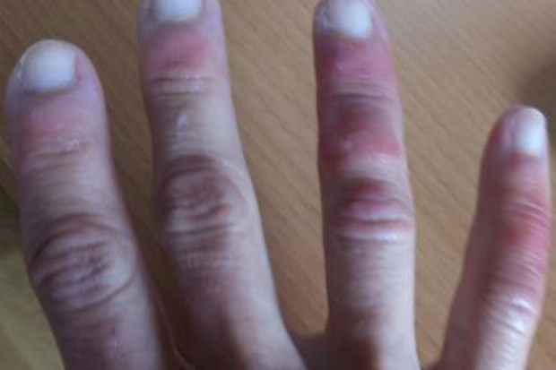 Some COVID-19 patients are developing a rash.