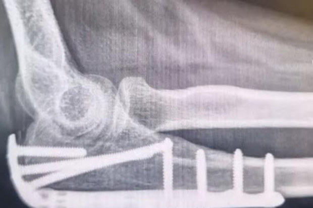 A pregnant single mum-to-be has called for action over ebikes after being badly hurt in a hit and run in Sydney CBD.Sarah Briscoe-Hough, 35, from Neutral Bay was heading to catch a bus after watching some of the Mardi Gras parade in Sydney in February.