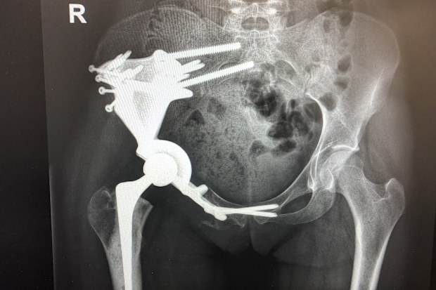 Surgeons removed the affected bone in her pelvis and replaced it with metal.