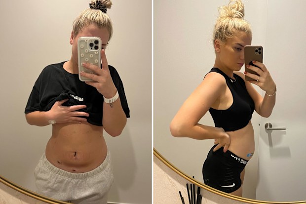 Surgery for endometriosis has left Ella Collings with scars on her stomach. It often leaves her severely bloated as well.