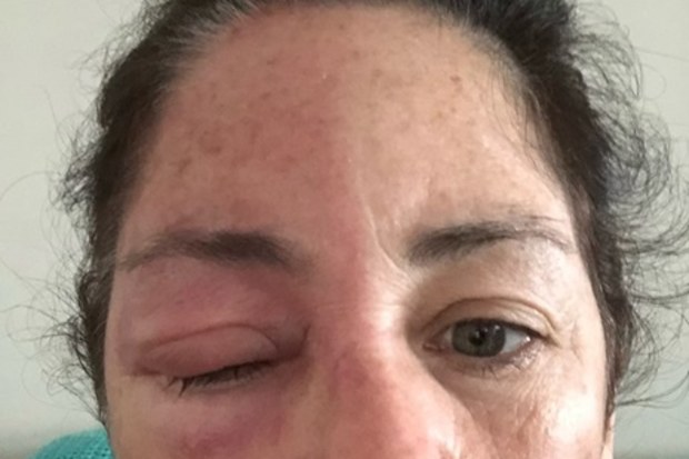 shingles awareness week justine