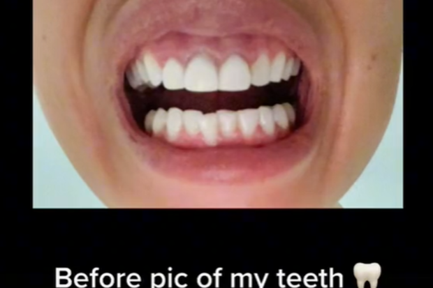 Influencer Jak Reid spends $5k on 'Turkey teeth'.
