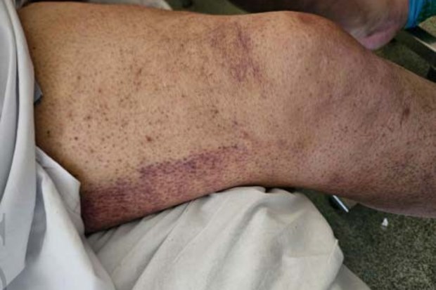 Man diagnosed with scurvy amid cost of living crisis, weight loss surgery