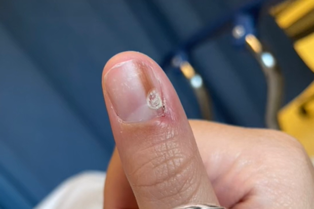 Cancer on finger