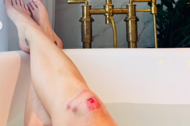 Katy Perry posts picture sof her crapped knees after she hurt herself on stage