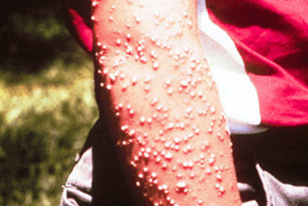 Pustules resulting from fire ant stings.