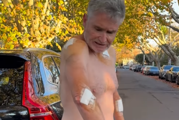 Dave Hughes covered in bandages after having five skin cancers removed