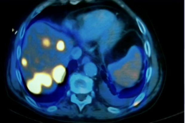 Early detection scans could help save thousands of lives.