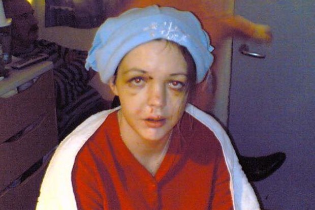 Woman who lost forehead in car crash shares warning