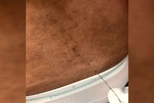 Florida mother has epidural stuck in her back days after giving birth