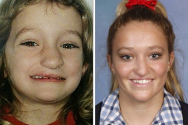 Jess Hosking as a child and teenager after several surgeries for her cleft lip and palate.