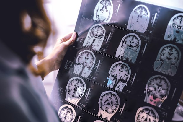 An MRI scan of a dementia patient