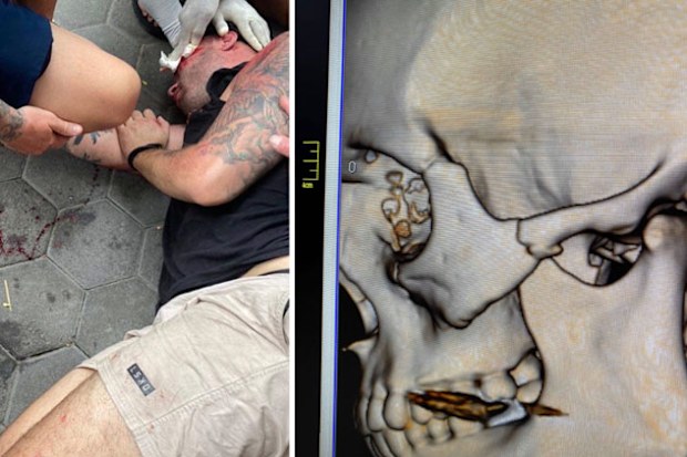 A photo of Cameron Johnson immediately after his scooter accident and an xray of his skull showing the fractures to his eye socket. 