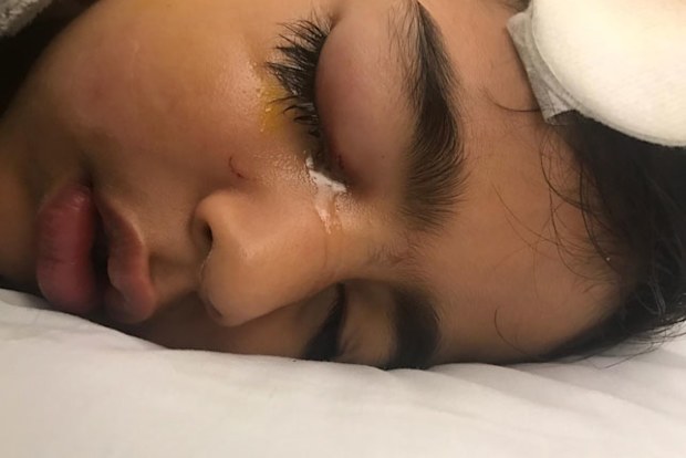 Saad's tear duct was torn and needed to be repaired.