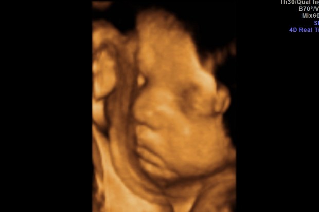 Pregnancy scan Melissa