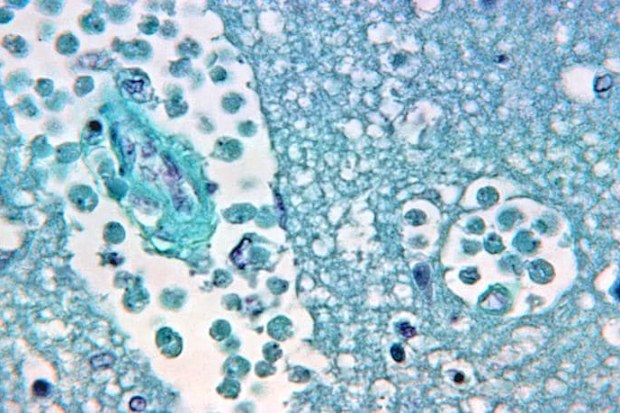 A brain tissue specimen after a Naegleria fowleri amoebic infection. 
