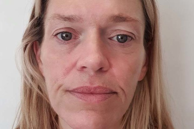 Jennei Hart, 49, from Melbourne, said doctors told her she has scurvy after complications related to the gastric band she had to help shed the kilos.