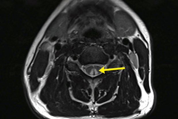 The inverted "V" sign as shown in this medical scan is evidence of spinal damage through nitrous oxide use.