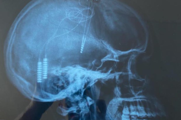 Sarah Otton has Parkinson's