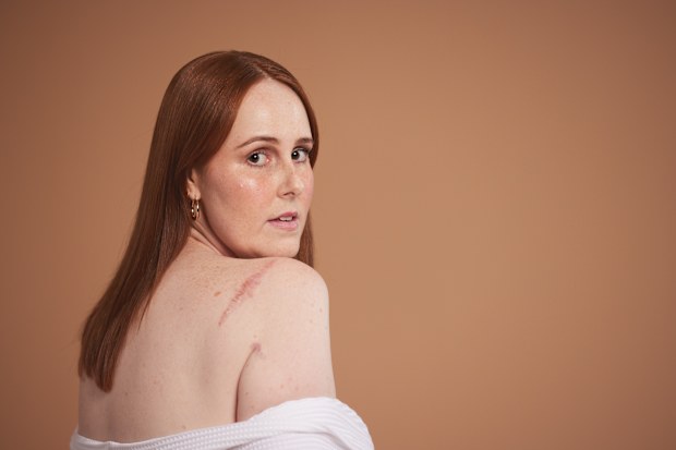 Skin cancer survivor Courtney Mangan for the Skin Check Champions campaign.