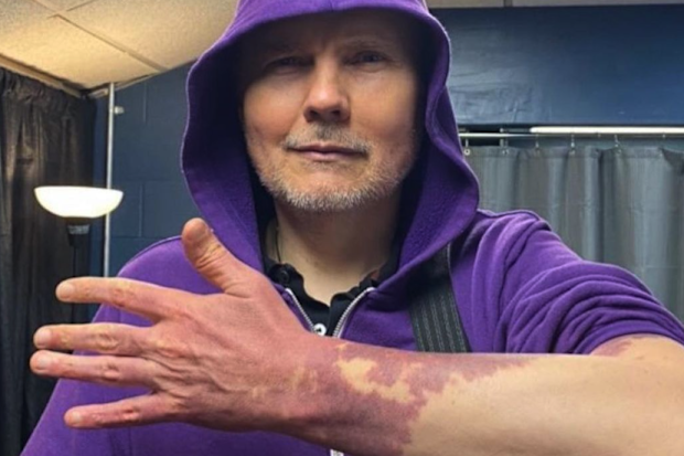 Smashing Pumpkins frontman Billy Corgan posing with his port wine birthmark.