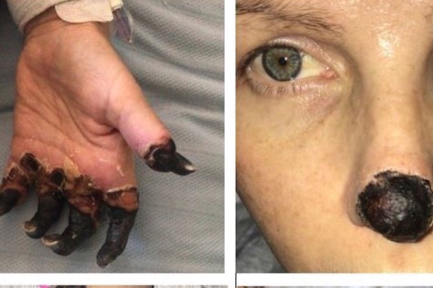 Mum’s chesty cough leads to leg and hand amputation