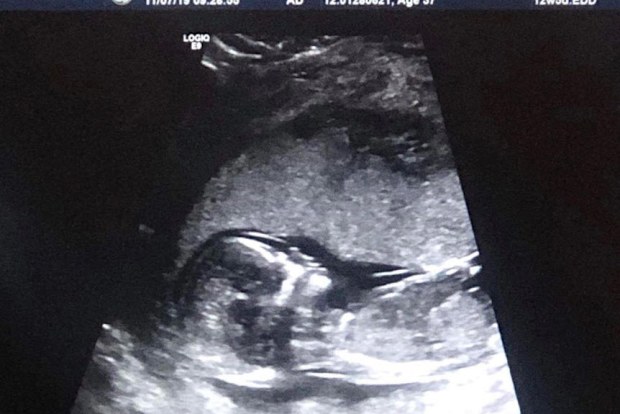 Premmie baby ultrasound