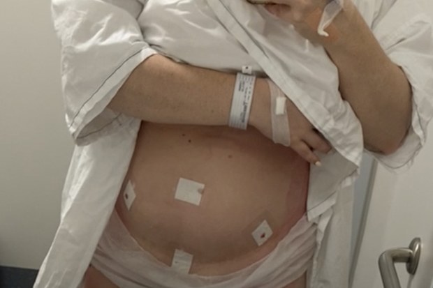 Surgery was needed to confirm Caitlin Tiernan's endometriosis diagnosis.