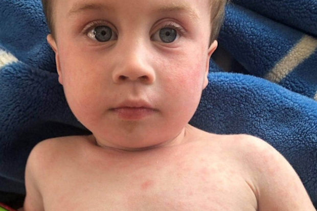 Nathan Cole extreme eczema 