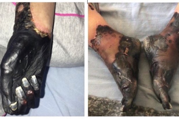 Mum’s chesty cough leads to leg and hand amputation