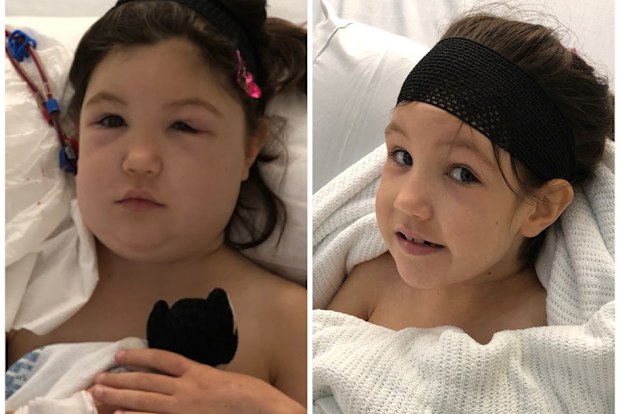 Lorelei's face was puffy and swollen (left), but mum Jen thought it was just allergies.