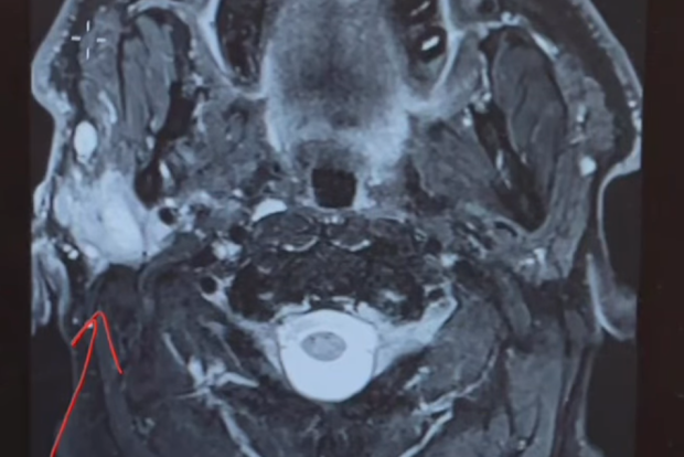 Scan showing Duncan Jones' cancer